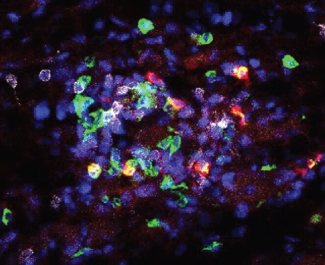 After injection and taking action against a solid tumor, SIVETs recruit and further activate a variety of T cells that are stained with different immunofluorescence reagents