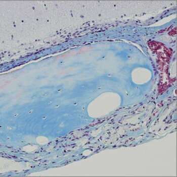 new bone structure has formed after stem cells were transplanted using the novel hydrogel strategy developed at the Wyss Institute